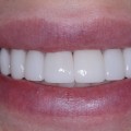 What Mental Health Services Teach Us About Confidence and the Benefits of Porcelain Veneers in Georgetown, TX