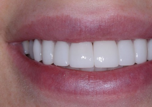 What Mental Health Services Teach Us About Confidence and the Benefits of Porcelain Veneers in Georgetown, TX